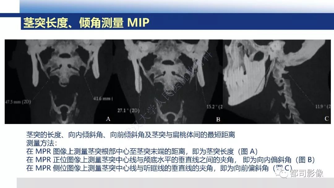 【PPT】茎突综合征影像诊断