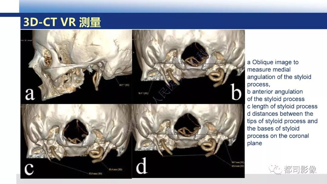 【PPT】茎突综合征影像诊断