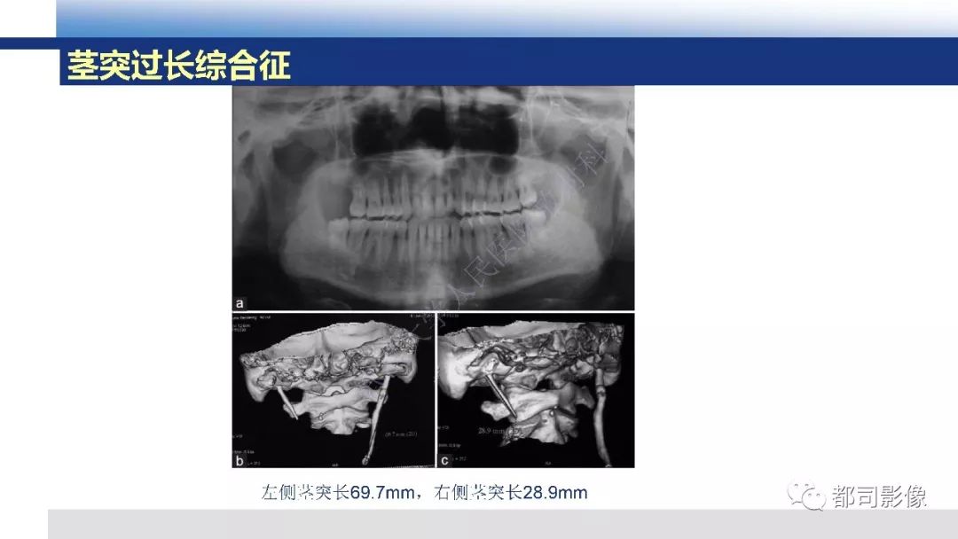 【PPT】茎突综合征影像诊断