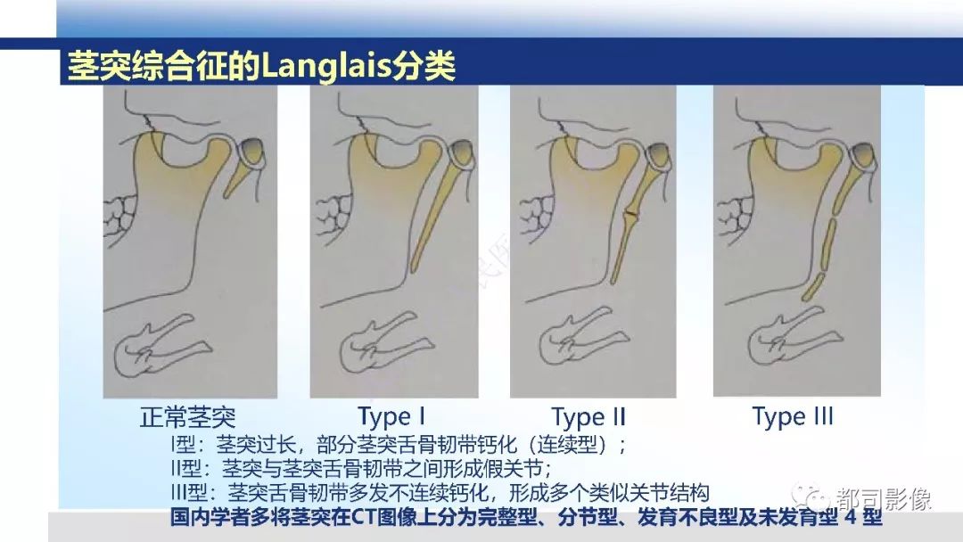 【PPT】茎突综合征影像诊断