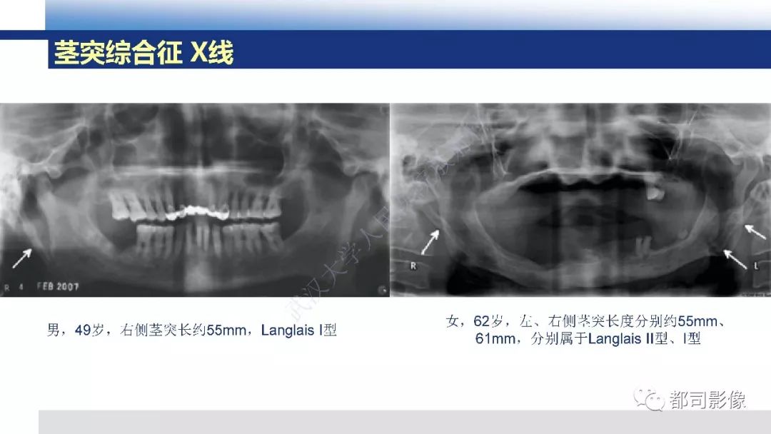【PPT】茎突综合征影像诊断