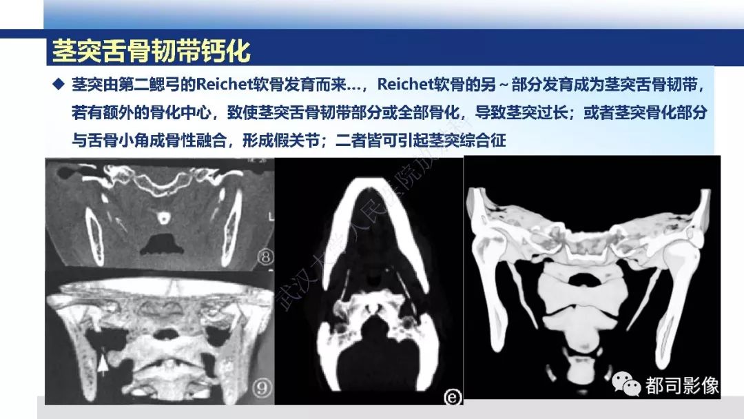 【PPT】茎突综合征影像诊断