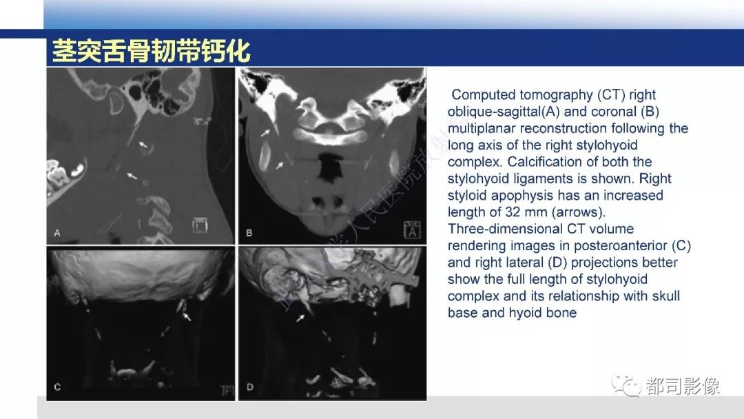 【PPT】茎突综合征影像诊断