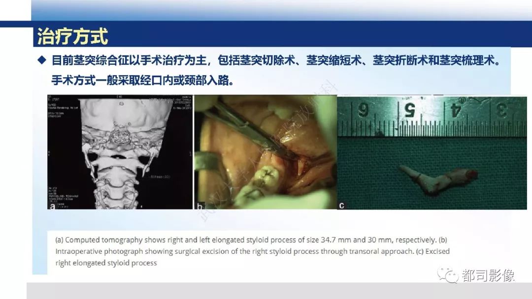 【PPT】茎突综合征影像诊断