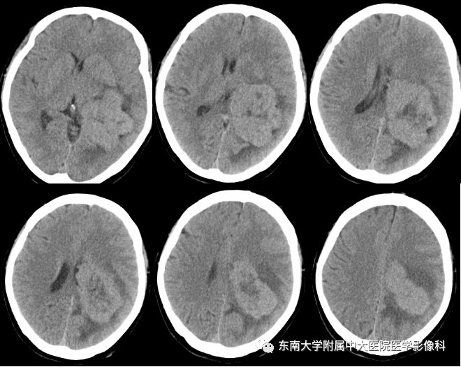 【病例】脑室内脑膜瘤1例CT及MR影像诊断