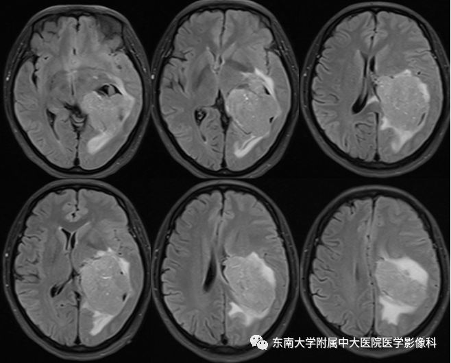 【病例】脑室内脑膜瘤1例CT及MR影像诊断