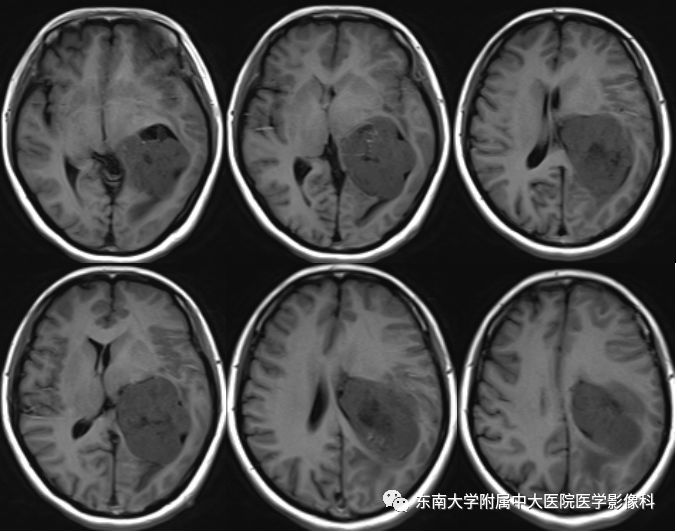 【病例】脑室内脑膜瘤1例CT及MR影像诊断