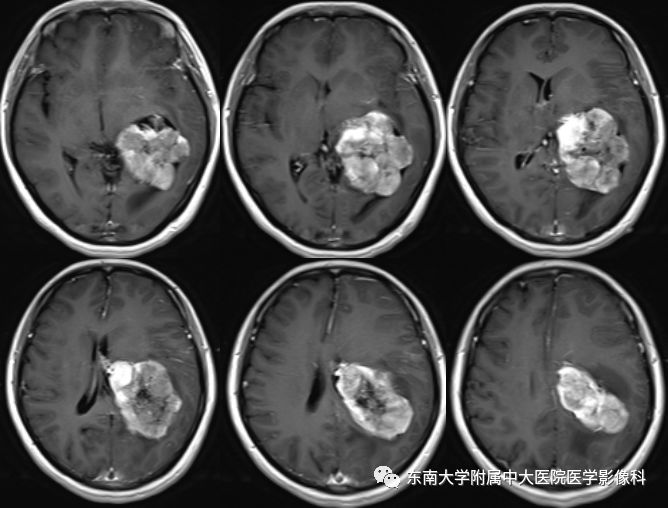 【病例】脑室内脑膜瘤1例CT及MR影像诊断