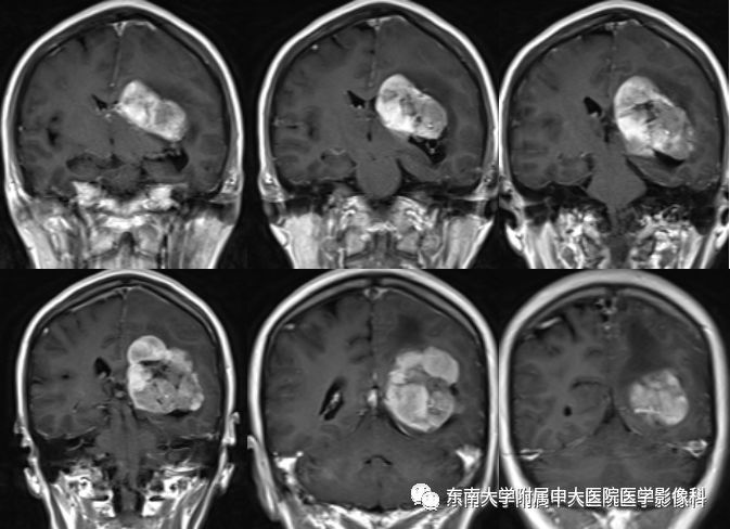 【病例】脑室内脑膜瘤1例CT及MR影像诊断
