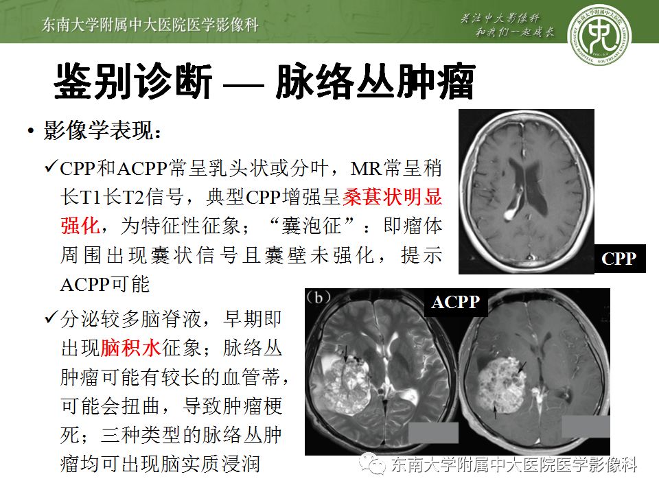 【病例】脑室内脑膜瘤1例CT及MR影像诊断