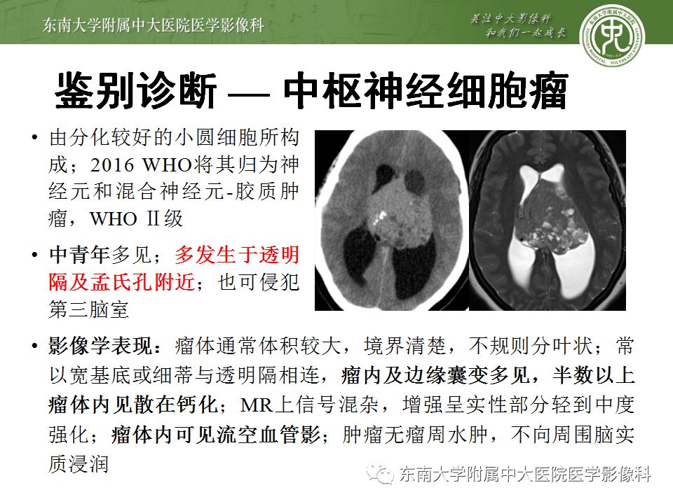【病例】脑室内脑膜瘤1例CT及MR影像诊断