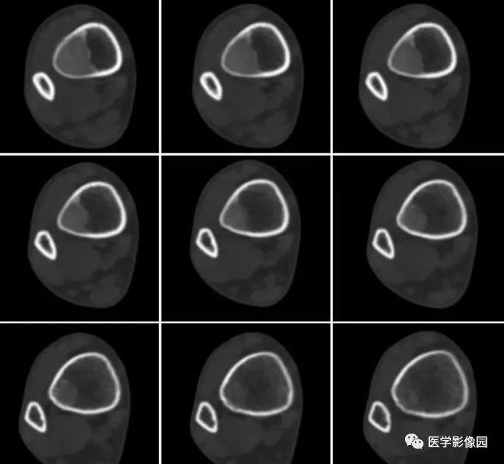 【病例】骨纤维结构不良1例CT影像表现 【病例】骨纤维结构不良1例CT影像表现