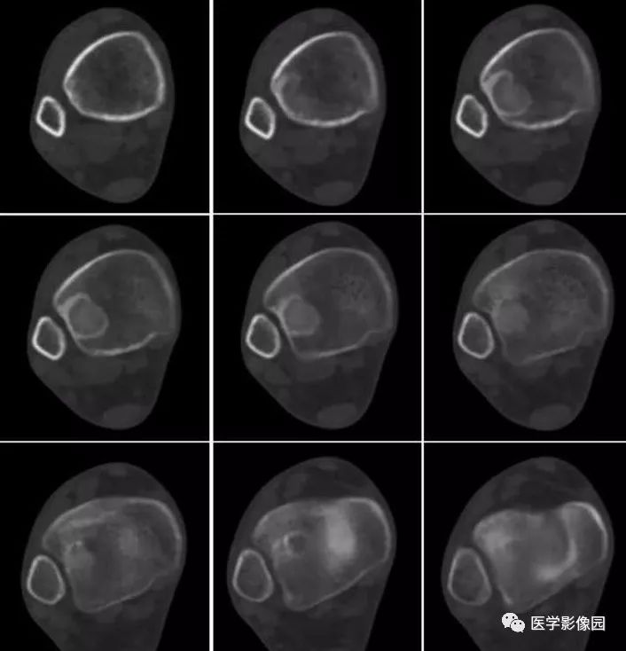 【病例】骨纤维结构不良1例CT影像表现 【病例】骨纤维结构不良1例CT影像表现