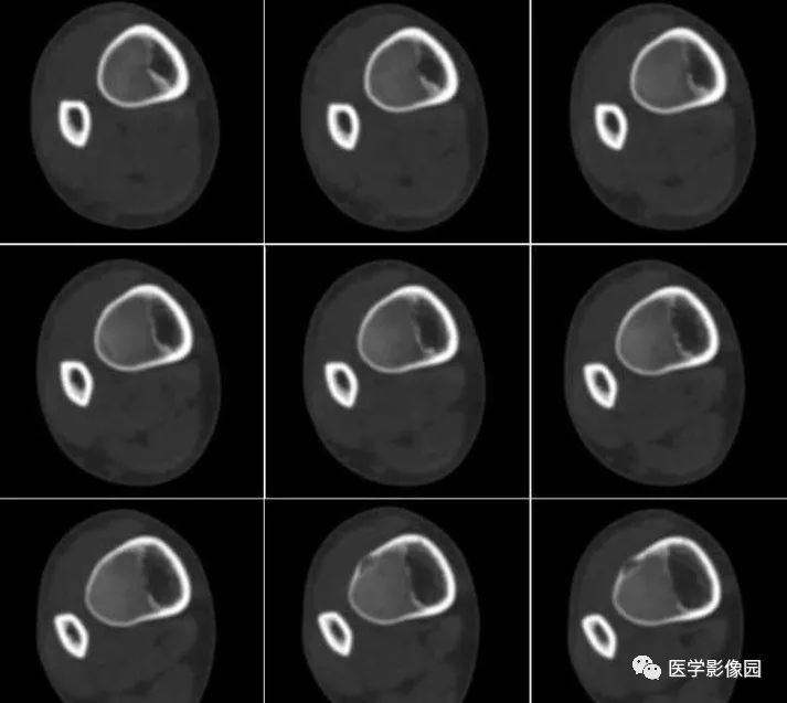 【病例】骨纤维结构不良1例CT影像表现 【病例】骨纤维结构不良1例CT影像表现