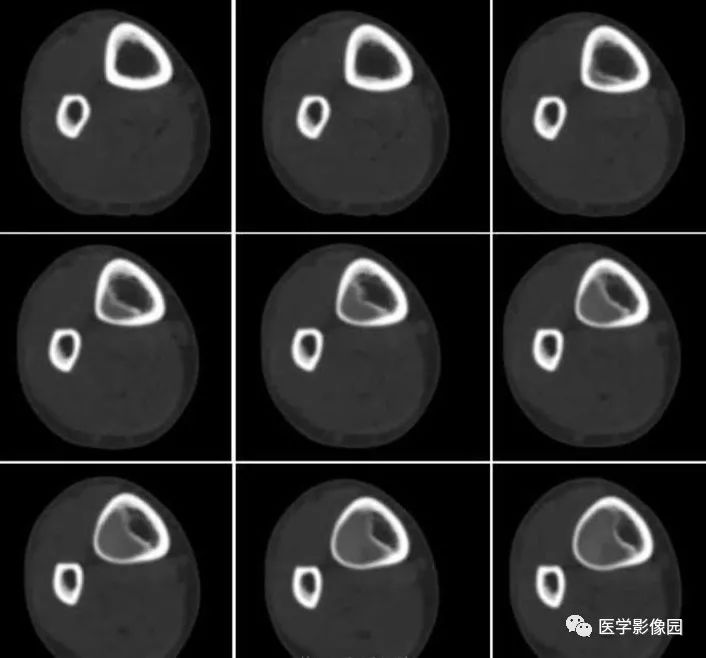【病例】骨纤维结构不良1例CT影像表现 【病例】骨纤维结构不良1例CT影像表现