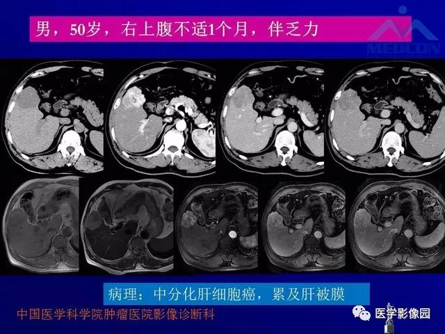 【PPT】肝脏富血供肿瘤CT、MRI诊断
