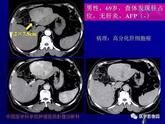 【PPT】肝脏富血供肿瘤CT、MRI诊断