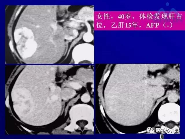 【PPT】肝脏富血供肿瘤CT、MRI诊断