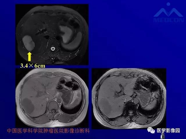 【PPT】肝脏富血供肿瘤CT、MRI诊断