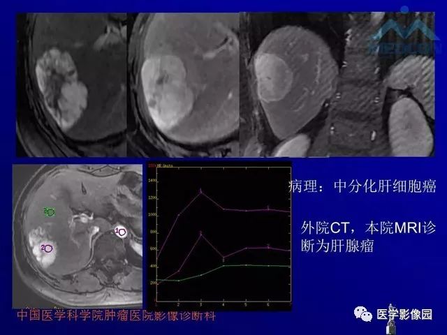 【PPT】肝脏富血供肿瘤CT、MRI诊断