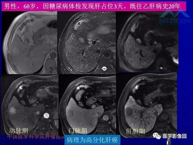 【PPT】肝脏富血供肿瘤CT、MRI诊断