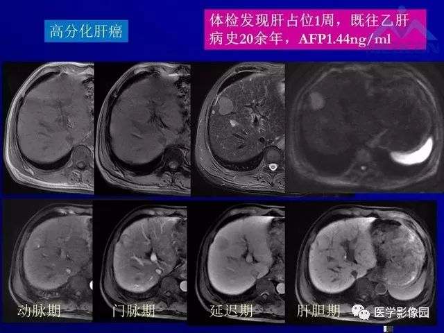 【PPT】肝脏富血供肿瘤CT、MRI诊断