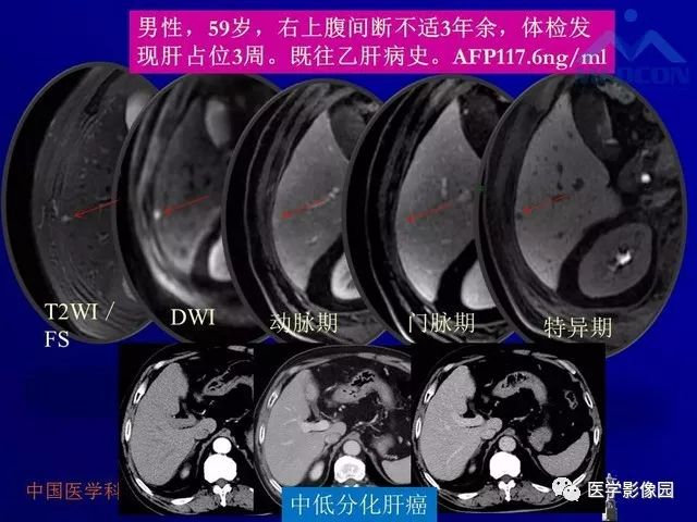 【PPT】肝脏富血供肿瘤CT、MRI诊断