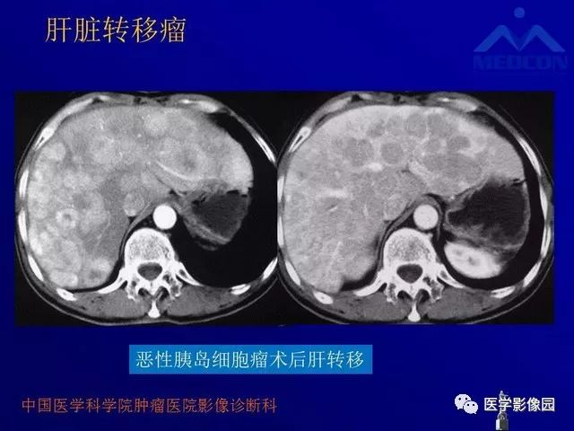 【PPT】肝脏富血供肿瘤CT、MRI诊断