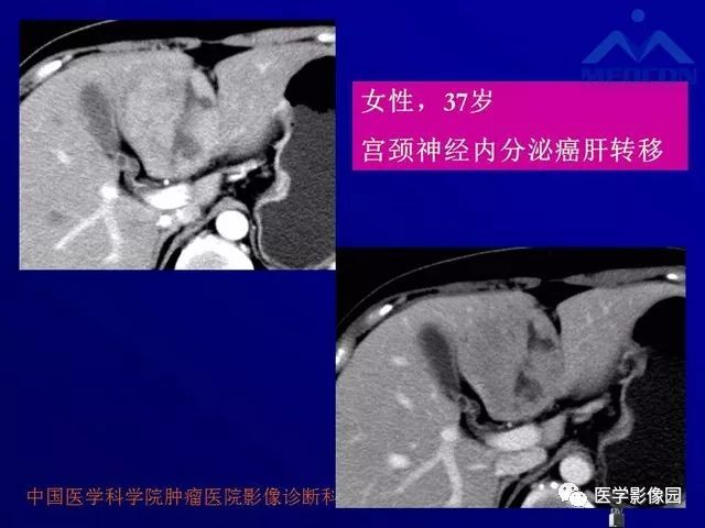 【PPT】肝脏富血供肿瘤CT、MRI诊断