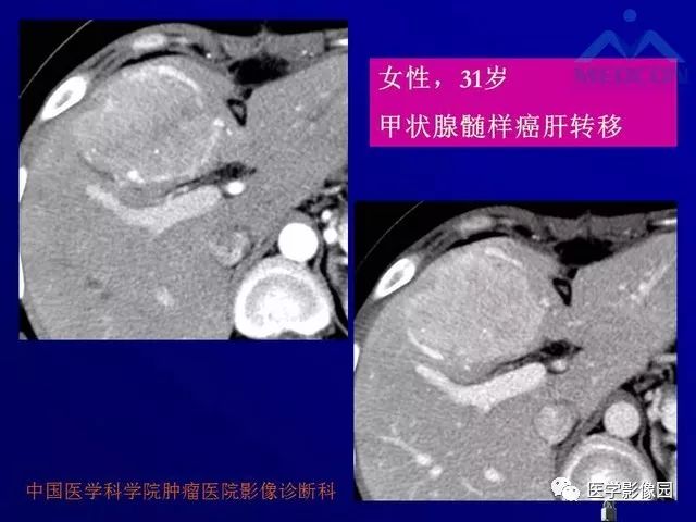 【PPT】肝脏富血供肿瘤CT、MRI诊断