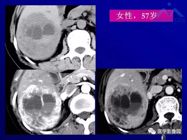 【PPT】肝脏富血供肿瘤CT、MRI诊断