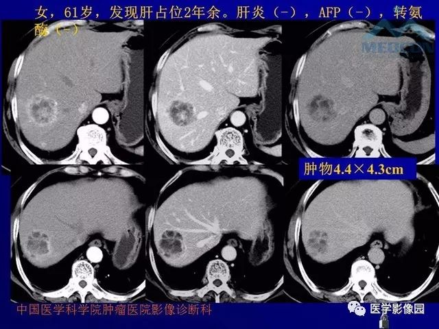 【PPT】肝脏富血供肿瘤CT、MRI诊断