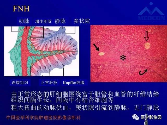 【PPT】肝脏富血供肿瘤CT、MRI诊断
