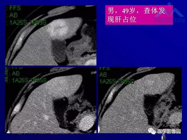 【PPT】肝脏富血供肿瘤CT、MRI诊断