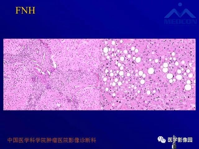 【PPT】肝脏富血供肿瘤CT、MRI诊断