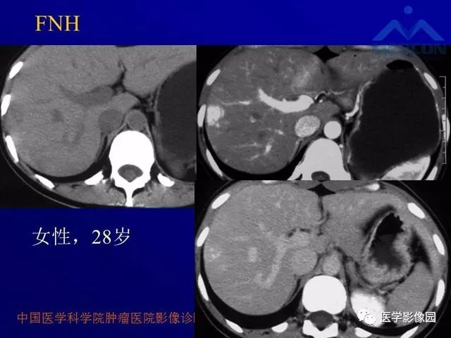 【PPT】肝脏富血供肿瘤CT、MRI诊断