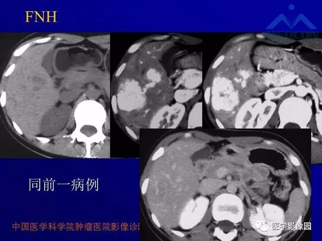 【PPT】肝脏富血供肿瘤CT、MRI诊断