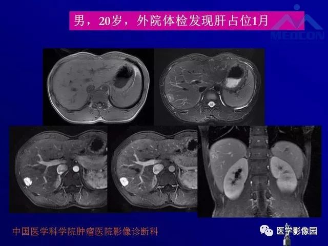 【PPT】肝脏富血供肿瘤CT、MRI诊断