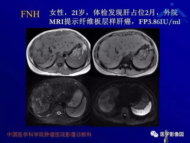 【PPT】肝脏富血供肿瘤CT、MRI诊断