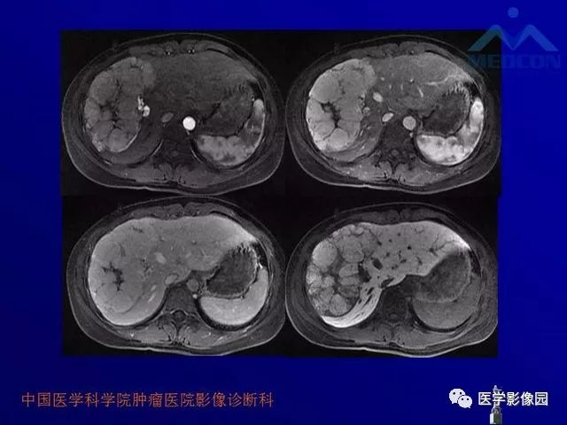 【PPT】肝脏富血供肿瘤CT、MRI诊断