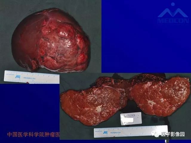 【PPT】肝脏富血供肿瘤CT、MRI诊断