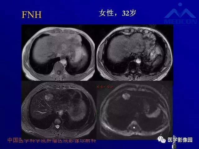 【PPT】肝脏富血供肿瘤CT、MRI诊断