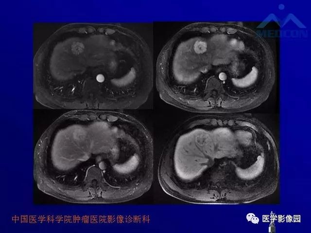 【PPT】肝脏富血供肿瘤CT、MRI诊断