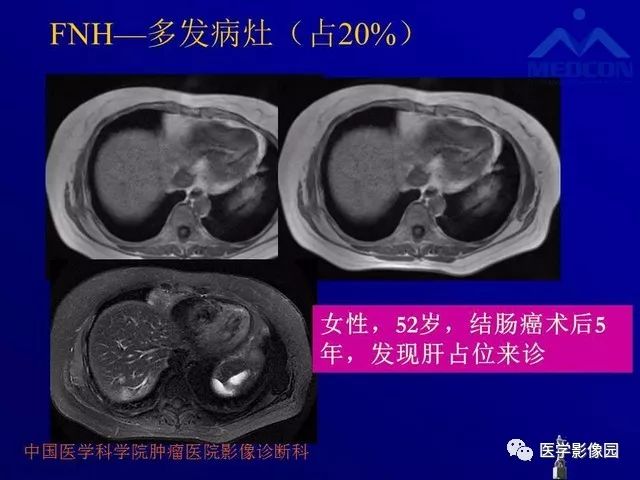 【PPT】肝脏富血供肿瘤CT、MRI诊断