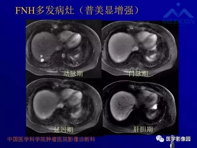 【PPT】肝脏富血供肿瘤CT、MRI诊断