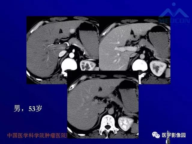【PPT】肝脏富血供肿瘤CT、MRI诊断