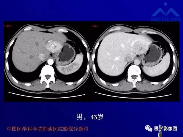 【PPT】肝脏富血供肿瘤CT、MRI诊断