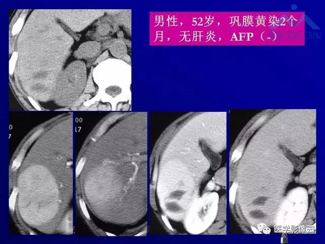 【PPT】肝脏富血供肿瘤CT、MRI诊断