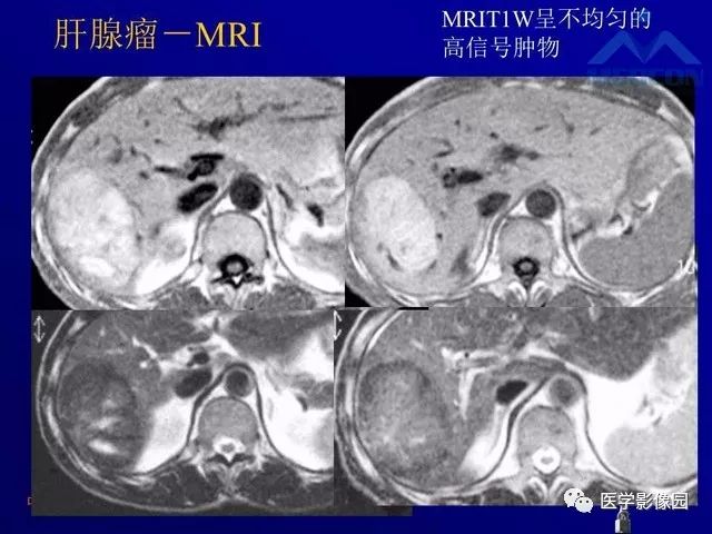 【PPT】肝脏富血供肿瘤CT、MRI诊断