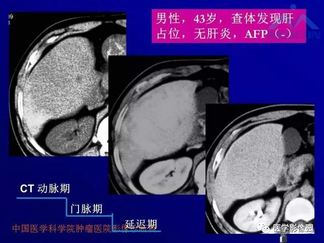 【PPT】肝脏富血供肿瘤CT、MRI诊断